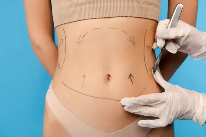 abdominoplastika